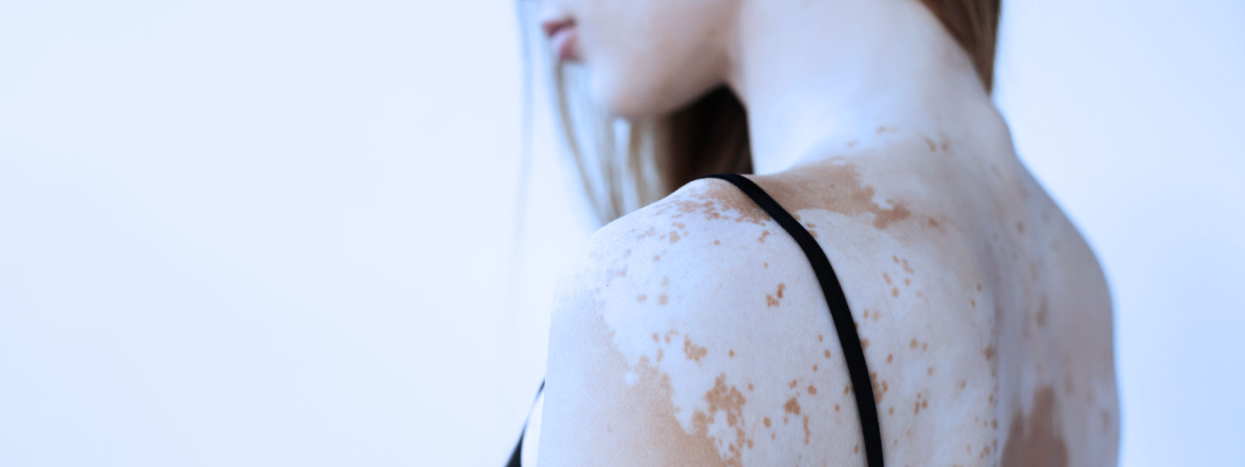 Troubles cutanés - vitiligo - Blogue du Réseau des massothérapeutes